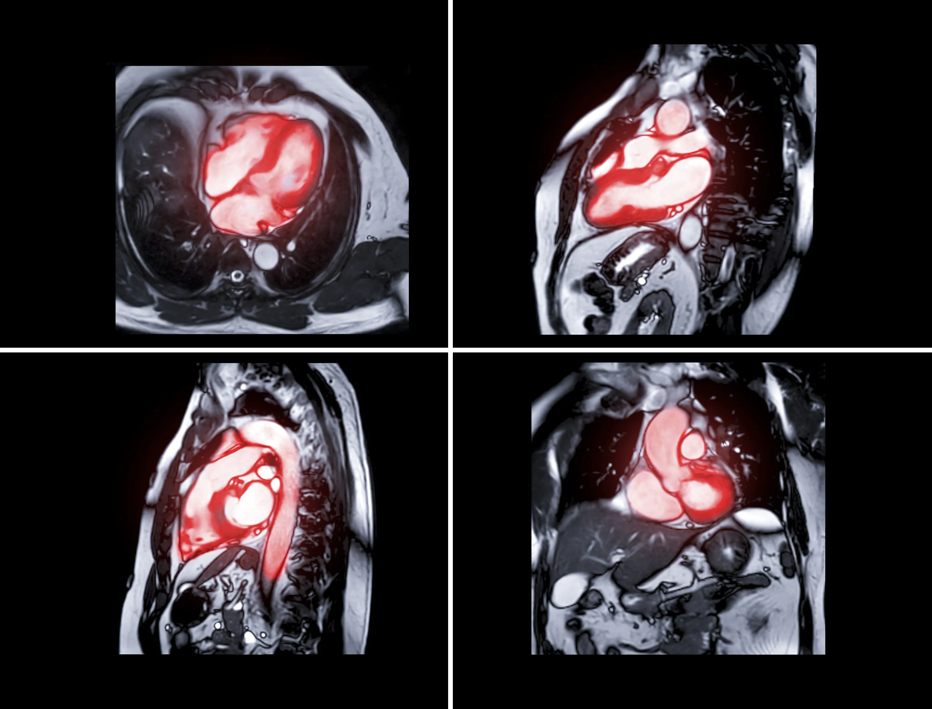 cardiac MRI