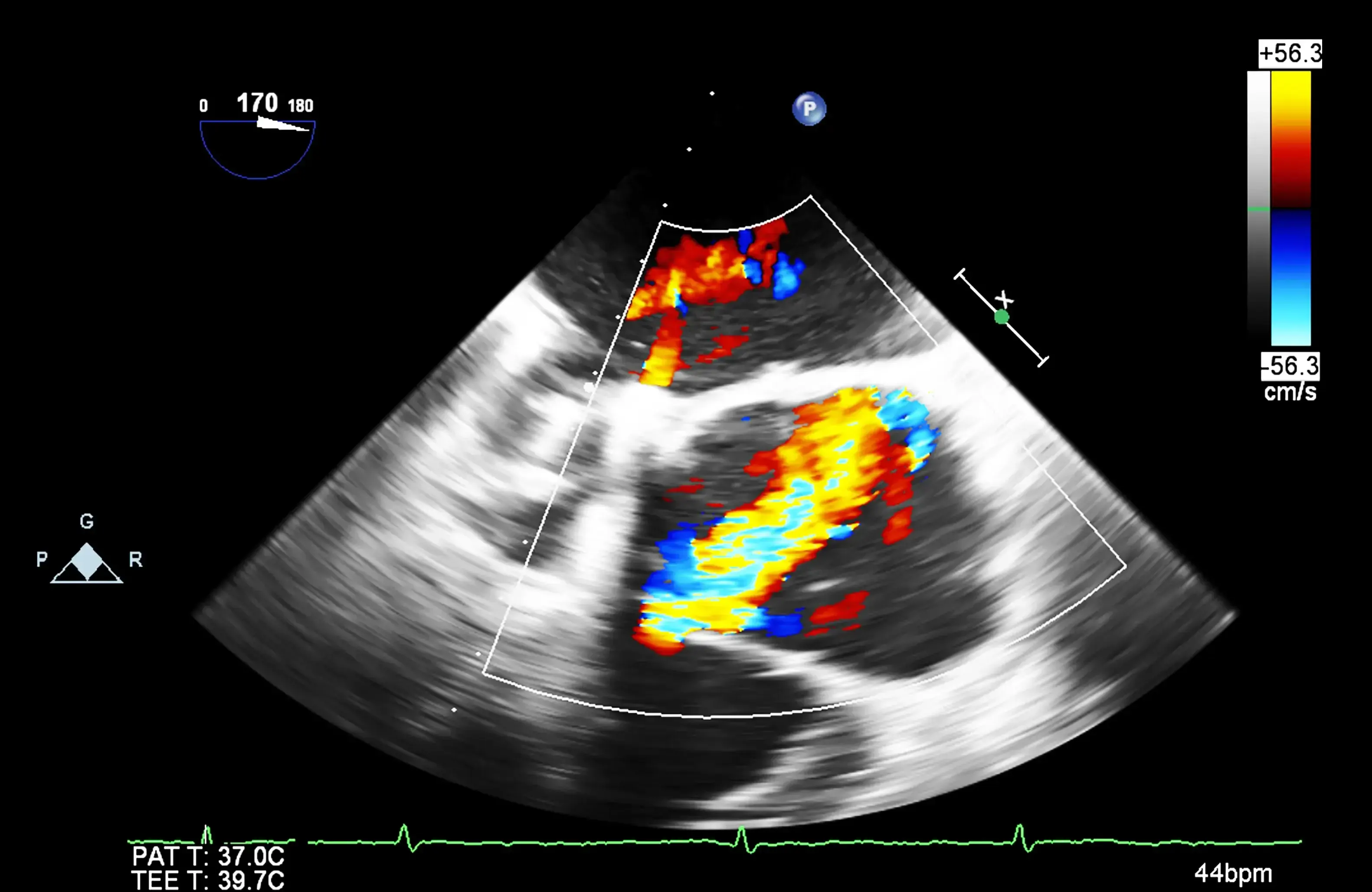 heart transesophageal ultrasound