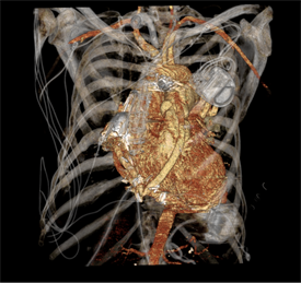 cardiac CT of a human heart