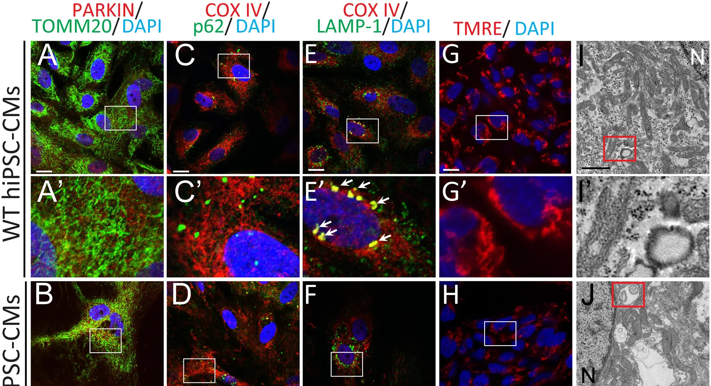 3 of 16, Fig. 1. Mitochondrial abnormalities and incomplete mitophagy in Danon hiPSC-CMs.