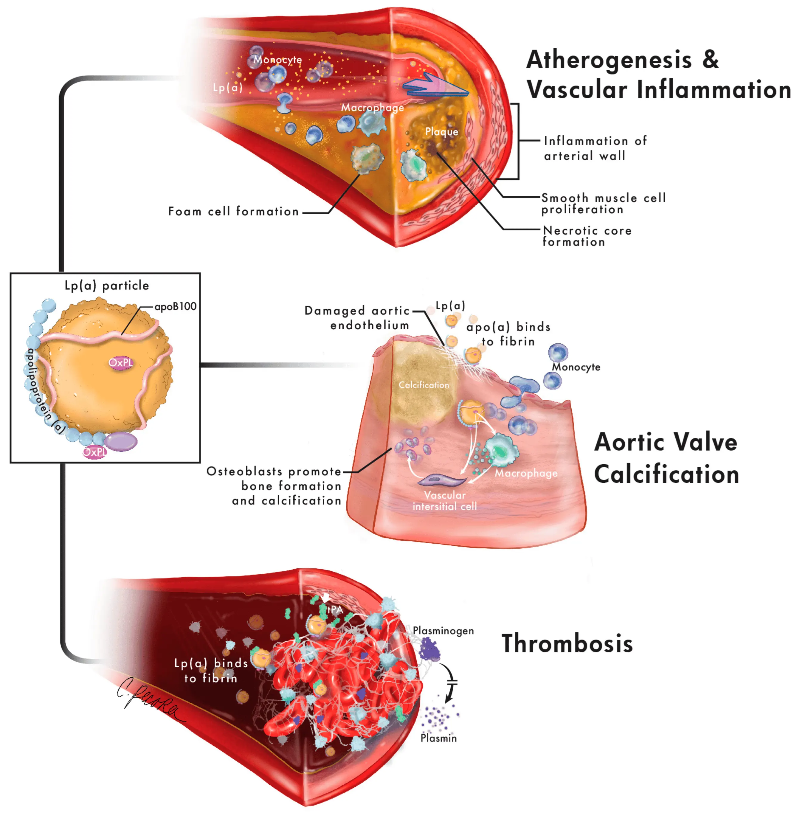 Figure showing mechanisms of cardiovascular risk related to Lp(a)